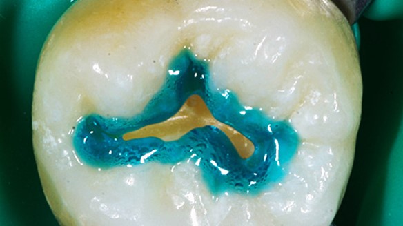 Gel acondicionador dental