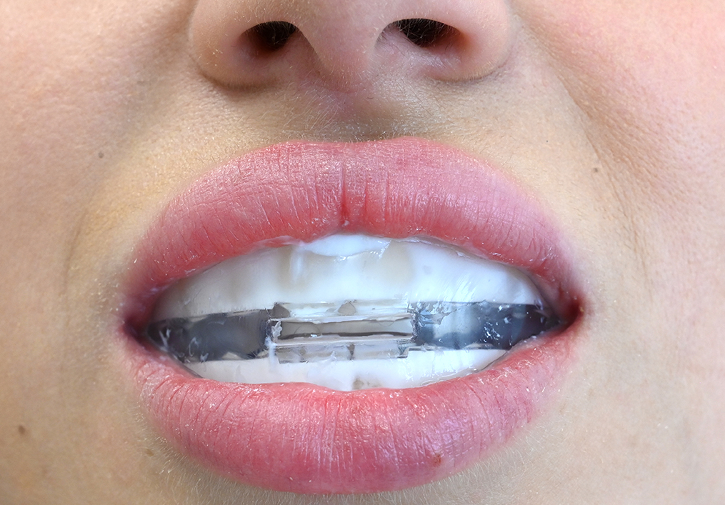 Juego de remineralización y MIH (dientes de tiza)