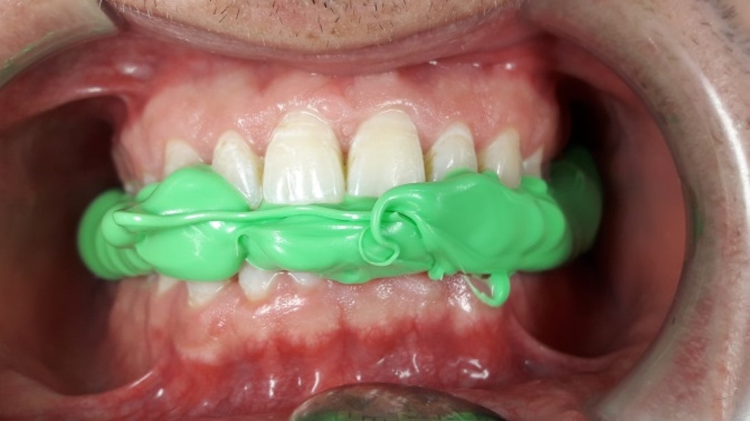 Hydroline thixotrop Clave
